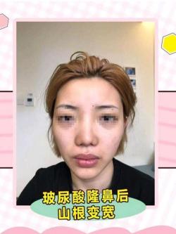 隆鼻手术恢复时间：影响因素及注意事项