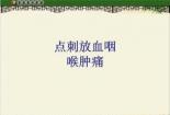 慢性咽炎如何治疗：综合中西医疗法，轻松管理咽部不适