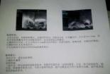 盆腔积液多少算正常：了解生理性与病理性盆腔积液