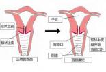 宫颈糜烂的治疗方案：药物治疗、物理治疗与手术治疗的选择