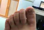 如何治疗灰指甲：简单有效的疗法与预防措施