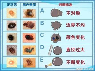 恶性黑色素瘤：预防、诊断与治疗的关键知识