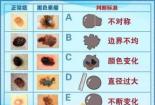 恶性黑色素瘤：预防、诊断与治疗的关键知识