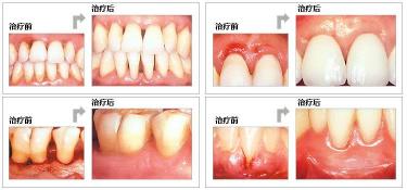 牙齿松动怎么治最好的办法：专业治疗、消炎药与日常口腔卫生