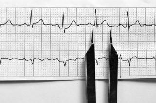 窦性心律失常：了解心跳的不规律现象