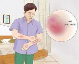 湿疹会传染吗：深入了解湿疹的传染性与预防措施