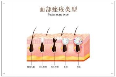 严重痤疮的治疗方法：从药物到生活护理的全面指南