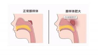 中医治疗小儿腺样体肥大：个性化方案与辨证论治的重要性