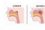 中医治疗小儿腺样体肥大：个性化方案与辨证论治的重要性
