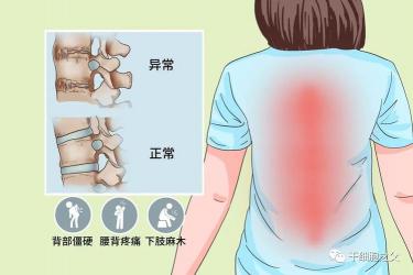 脊柱炎的症状：从早期到晚期，全面解析疾病的演变过程