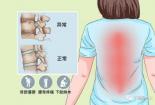 脊柱炎的症状：从早期到晚期，全面解析疾病的演变过程