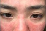 脸上起红疹：原因、应对方法和预防措施