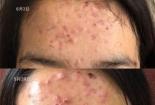 脂溢性痤疮：揭秘皮肤问题的根源与防治之道