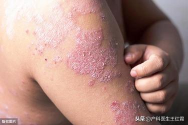 过敏性湿疹症状解析：认识、应对与康复指南
