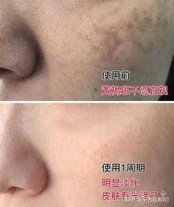 长黄褐斑的真相：揭秘背后的原因