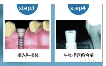 一般植入一颗牙多少钱？费用因素与选择全解析