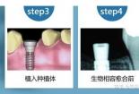 一般植入一颗牙多少钱？费用因素与选择全解析