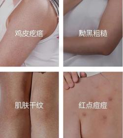 全面解析：如何有效去除鸡皮疙瘩，恢复光滑肌肤