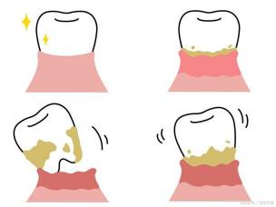 牙周炎能治好吗？牙周炎治疗分阶段详解，让你远离牙齿疾病困扰