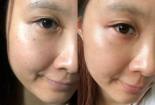 更年期黄褐斑不再愁，光子嫩肤助你重拾自信