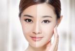 黄褐斑去除方法大揭秘：自然、健康、安全，让你重拾美丽肌肤！