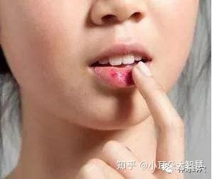 宝宝嘴唇干怎么办？三大方法助你轻松缓解干燥问题
