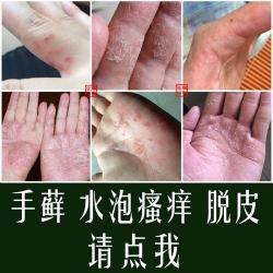 水疱型手癣：症状、治疗与日常护理全攻略