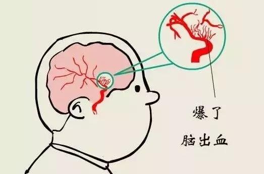 颅内动脉瘤：认识它，守护你的大脑安全