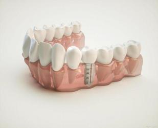 种植牙能用多长时间：决定因素与延长寿命的秘诀