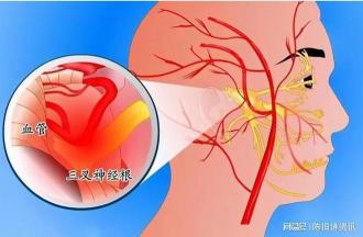 如何治疗面瘫：专家解析物理与心理治疗的双重策略