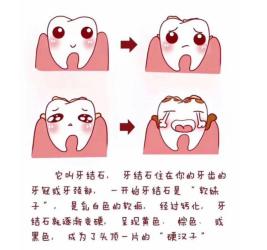 牙结石的成因与防治：守护口腔健康的必修课