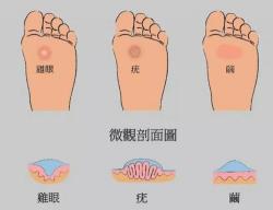 指甲周围长倒刺的原因：了解成因与预防措施