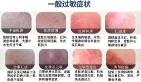 治疗皮肤过敏的方法：5种有效途径让你告别敏感困扰！
