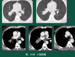 认识小细胞肺癌：恶性程度高，早期发现与治疗至关重要