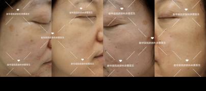 治疗黄褐斑最好的医院：选择安全与效果的明智之举