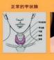 甲状腺肿瘤的治疗与护理：手术治疗、内分泌治疗与核素治疗