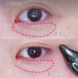 消除眼部细纹的五步策略：从眼霜到肉毒素注射