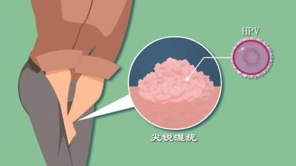 尖锐湿疣能否治愈？现代医学给出的答案