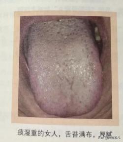 女子阳性高烧后舌头长满厚白舌苔，揭示肠胃问题