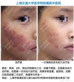 胎记去除：激光疗法引领安全高效的治疗方式