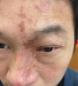 面瘫病因：带状疱疹病毒与心理因素共同作用