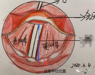 声带麻痹：原因、症状及治疗方法