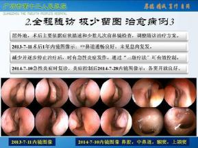鼻窦炎好治疗吗？大多数病例可以治愈