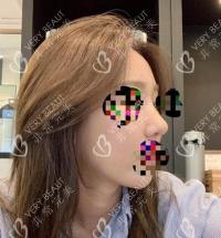 鼻尖整形美容术：打造完美鼻尖的手术选择